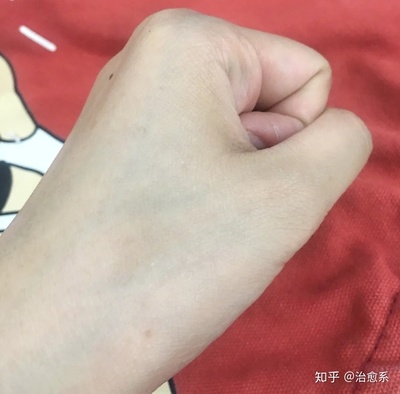 烫伤怎样不留疤痕