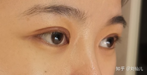 割双眼皮一个月了还需要忌口吗