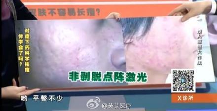 点阵激光治痘痘多少钱一次