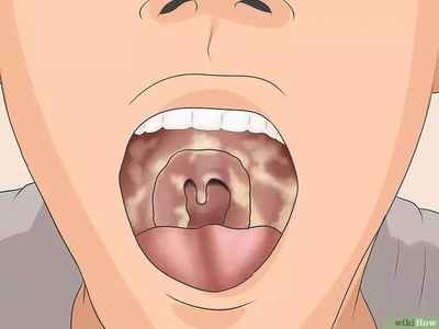 喉咙有红点是怎么回事