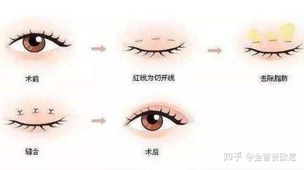 拉双眼皮