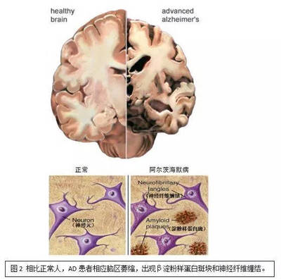 大脑萎缩是怎么回事