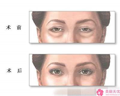 眼部整形美容价钱
