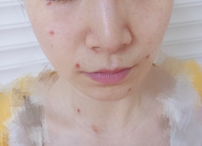点痣后多久不能晒太阳