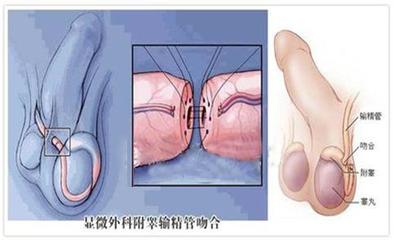 附睾囊肿怎么治疗