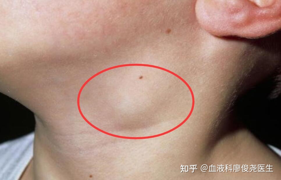 一岁宝宝耳后淋巴结肿大怎么办