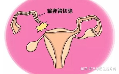 一根输卵管能怀孕吗