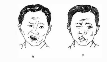 左脸发麻是怎么回事