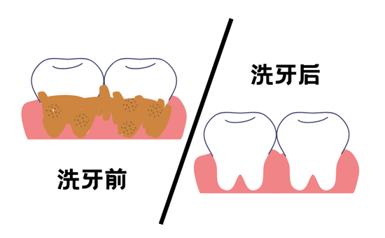 洗牙前要刷牙吗