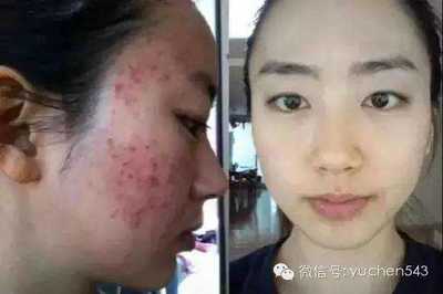 吃辣脸上长痘痘怎么办