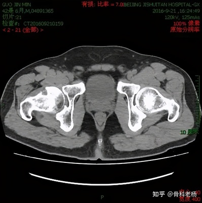 ect骨骼检查多少钱