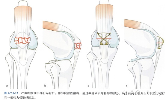 膝盖髌骨骨折怎么治疗