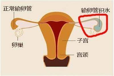 输卵管不通是怎么回事