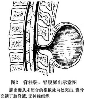 脊膜囊受压怎么治疗