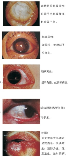 眼部增生是什么引起的
