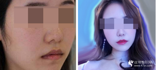 衡阳 痘痘