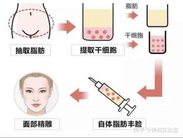 脂肪填充还是玻尿酸好