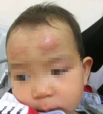 宝宝退烧后脸上起红疹