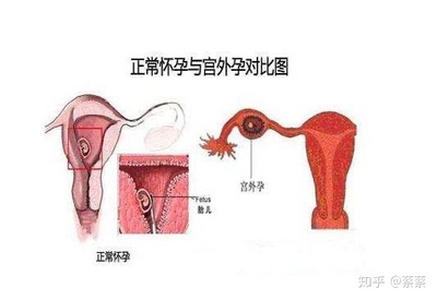 刮宫是怎么回事