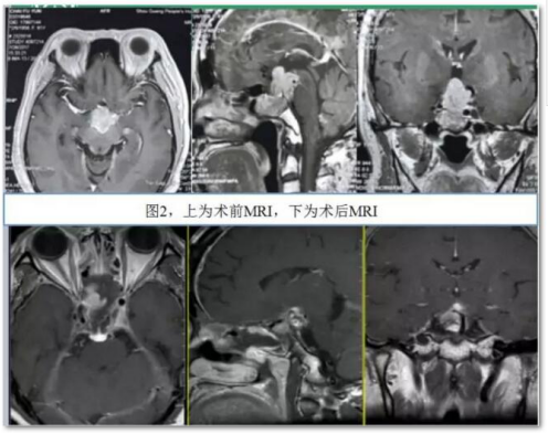 脑垂体瘤怎么治疗