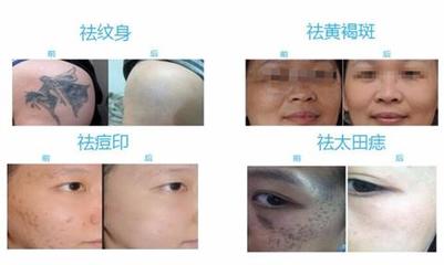 皮秒激光可以祛痘印吗
