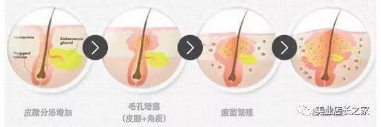 排毒的痘痘怎么调理