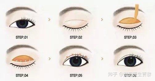 双眼皮有几种做法