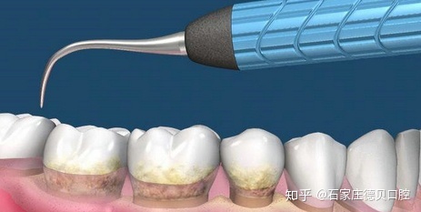 怀孕可以洗牙嘛
