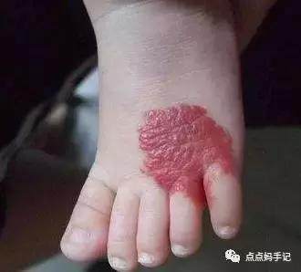 新生儿血管瘤