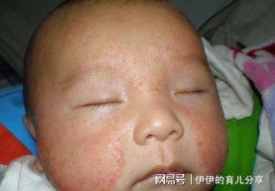 满月宝宝起湿疹怎么办