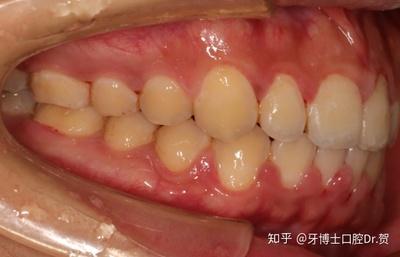 矫正牙齿对牙齿好吗