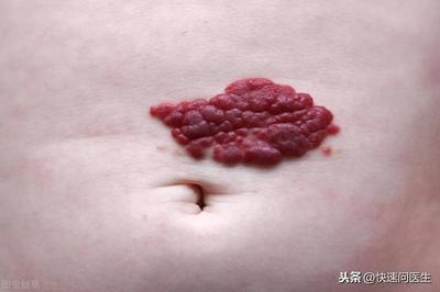 红痣是怎么回事
