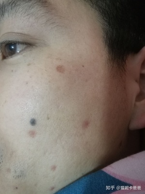 多大的痣可以用激光点