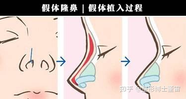 做假体隆鼻取出