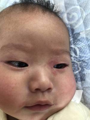 宝宝眼睛好多眼屎
