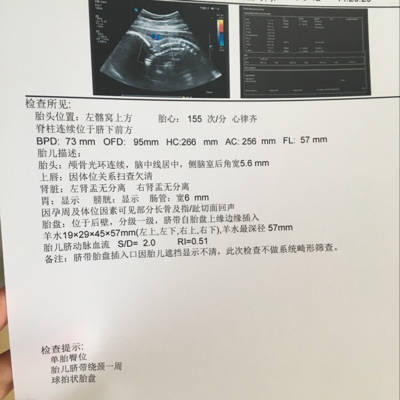 胎儿绕颈三周