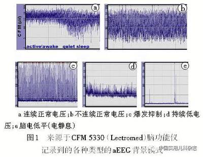 新生儿做脑电图有影响吗
