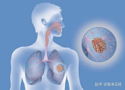 呼吸道感染要怎么治疗