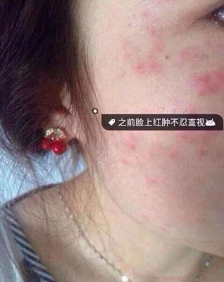 葡萄籽能去脸上痘痘吗