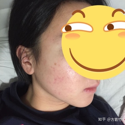 心口上长痘痘是怎么回事啊