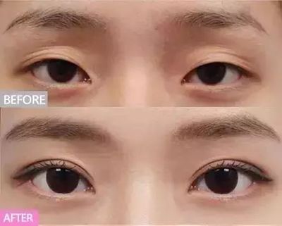 割双眼皮眼型