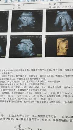 胎儿单肾