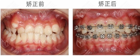 矫正牙齿前后