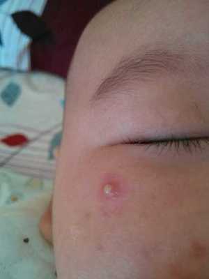 两岁宝宝脸上长痘痘