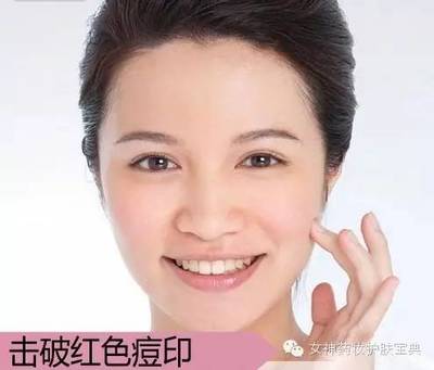 根除痘痘 痘印