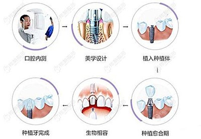 美学基台需要多少钱