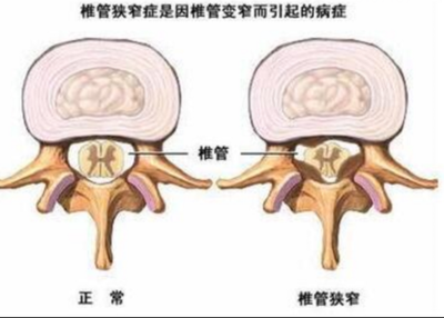 腰椎狭窄怎么治疗效果最好
