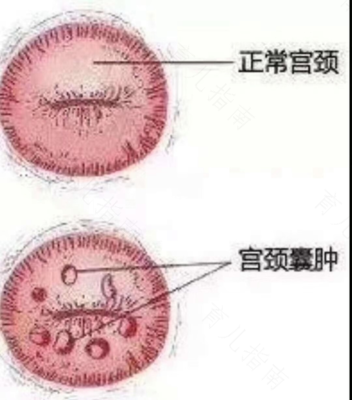 宫颈纳囊怎么治疗最好的方法