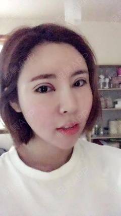 做完双眼皮冰敷多久