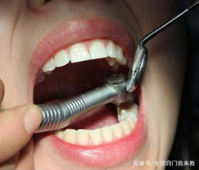 拔牙后多久恢复正常